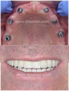 Üst çene 6 implant üzeri sabit diş köprüsü zirkonyum kaplama öncesi