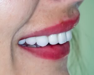 Diş Hekimi Sertaç Kızılkaya İstanbul Avrupa yakasıÖn diş estetiği zirkonyum diş kaplama ile