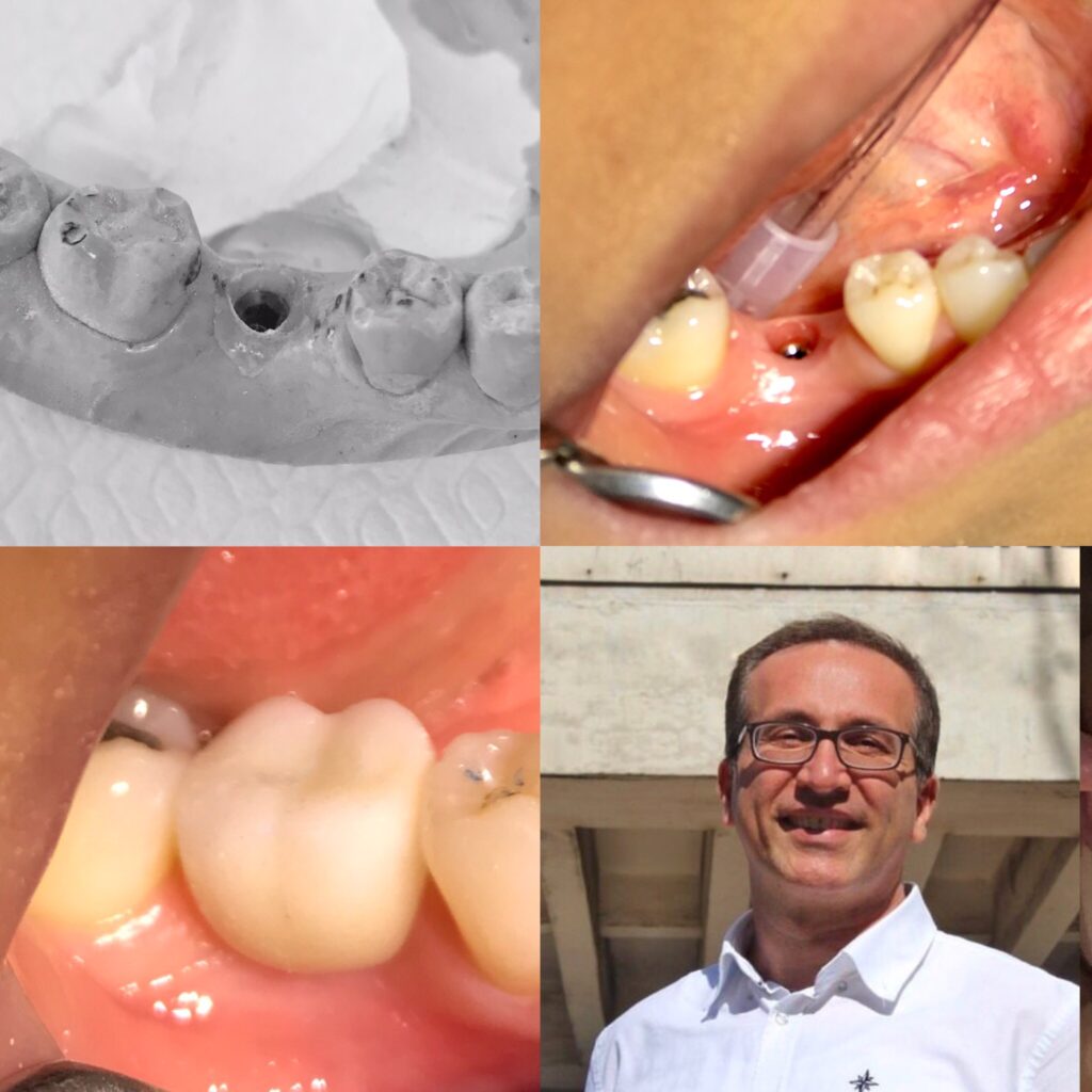 İmplant diş nasıl yapılır Diş Hekimi Sertaç Kızılkayaİmplant diş nasıl yapılır Diş Hekimi Sertaç Kızılkaya