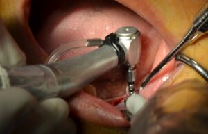 İmplant yapımı İstanbul İmplant kliniği Türkiye