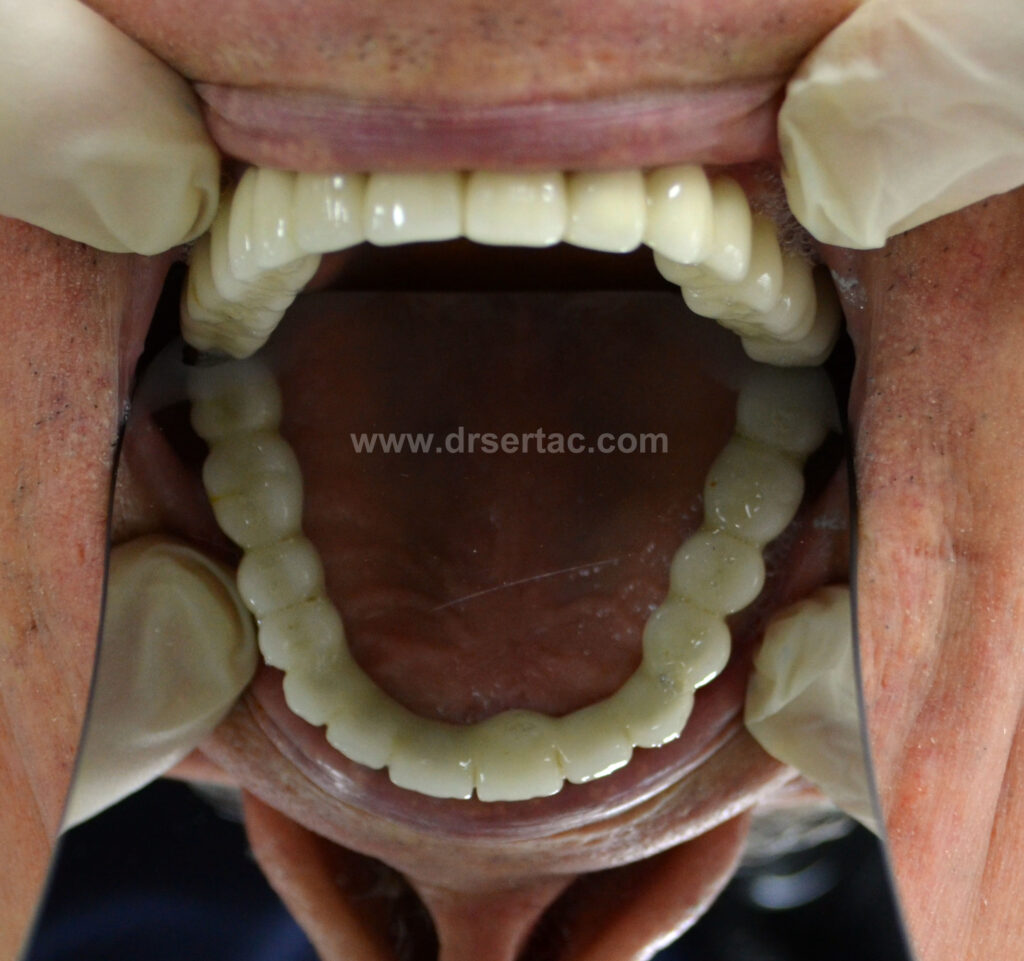 Üst çene implant üzeri zirkonyum diş kaplama örneği Diş Hekimi Sertaç Kızılkaya